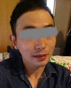 남자 안면윤곽 코 수술 6개월