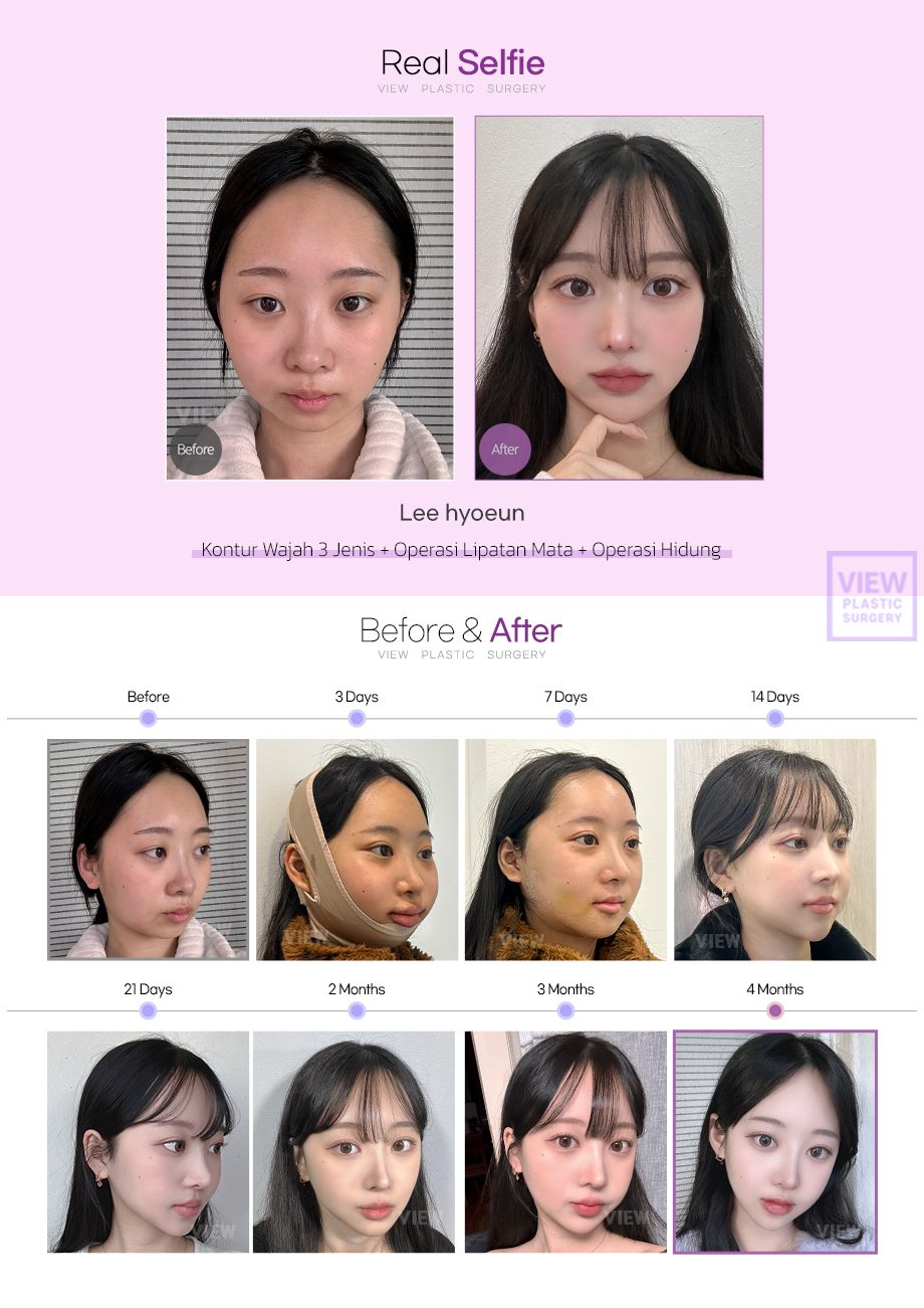 [Kontur Wajah 3 Jenis+Operasi Lipatan Mata+Operasi Hidung] 