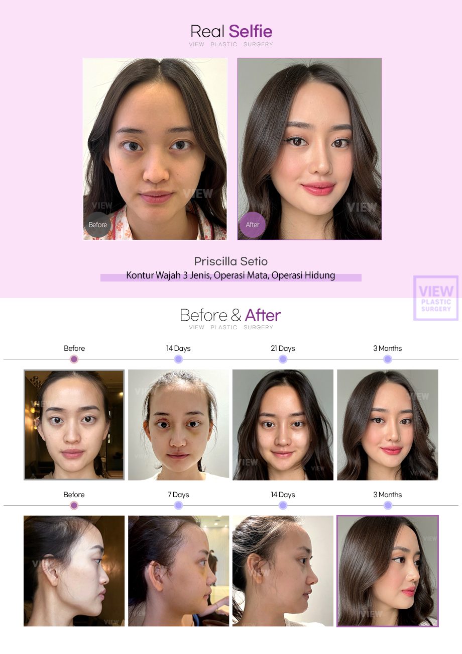 Kontur Wajah 3 Jenis, Operasi Mata, Operasi Hidung