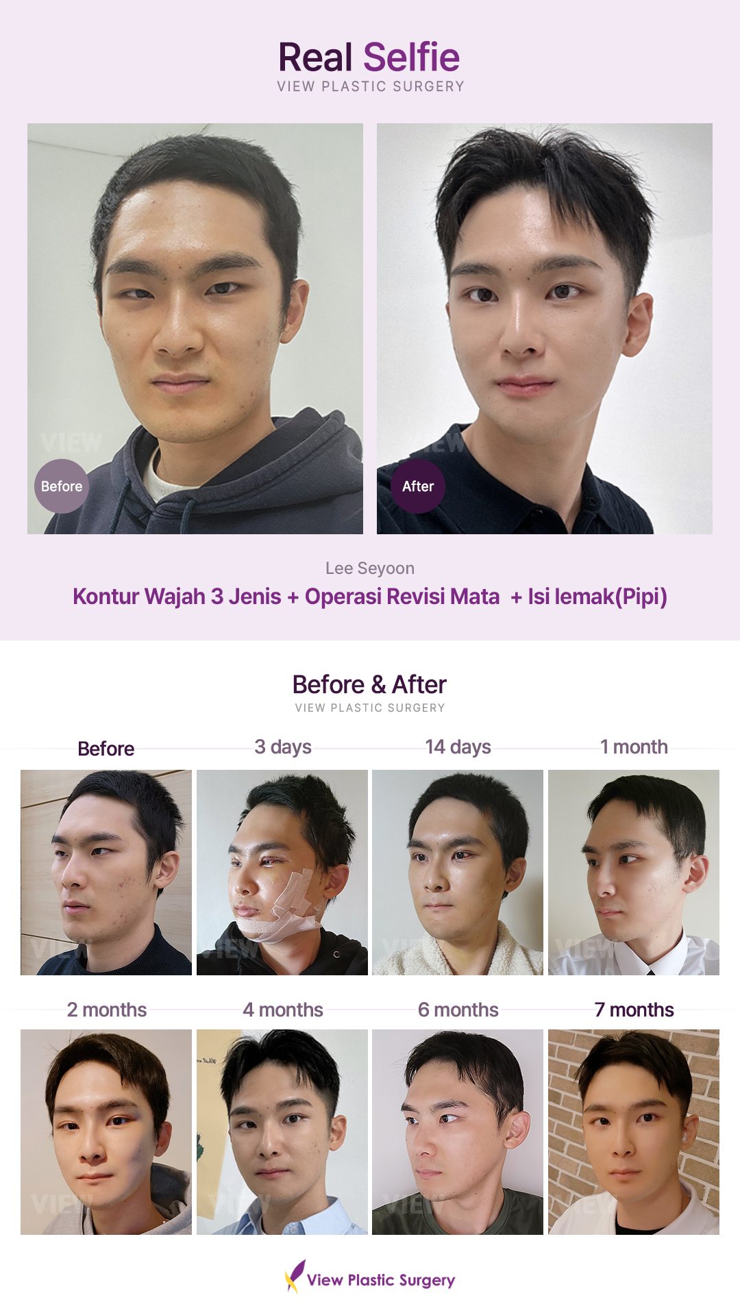 Kontur Wajah 3 Jenis + Operasi Revisi Mata  + Isi lemak(Pipi)