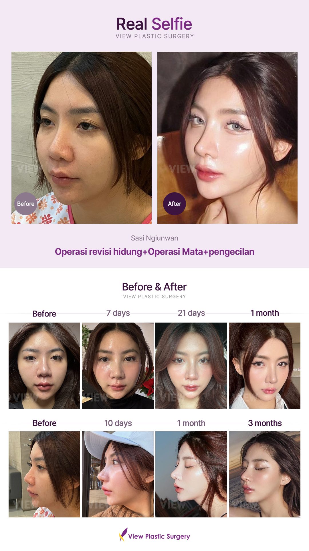 Operasi revisi hidung+Operasi Mata+pengecilan