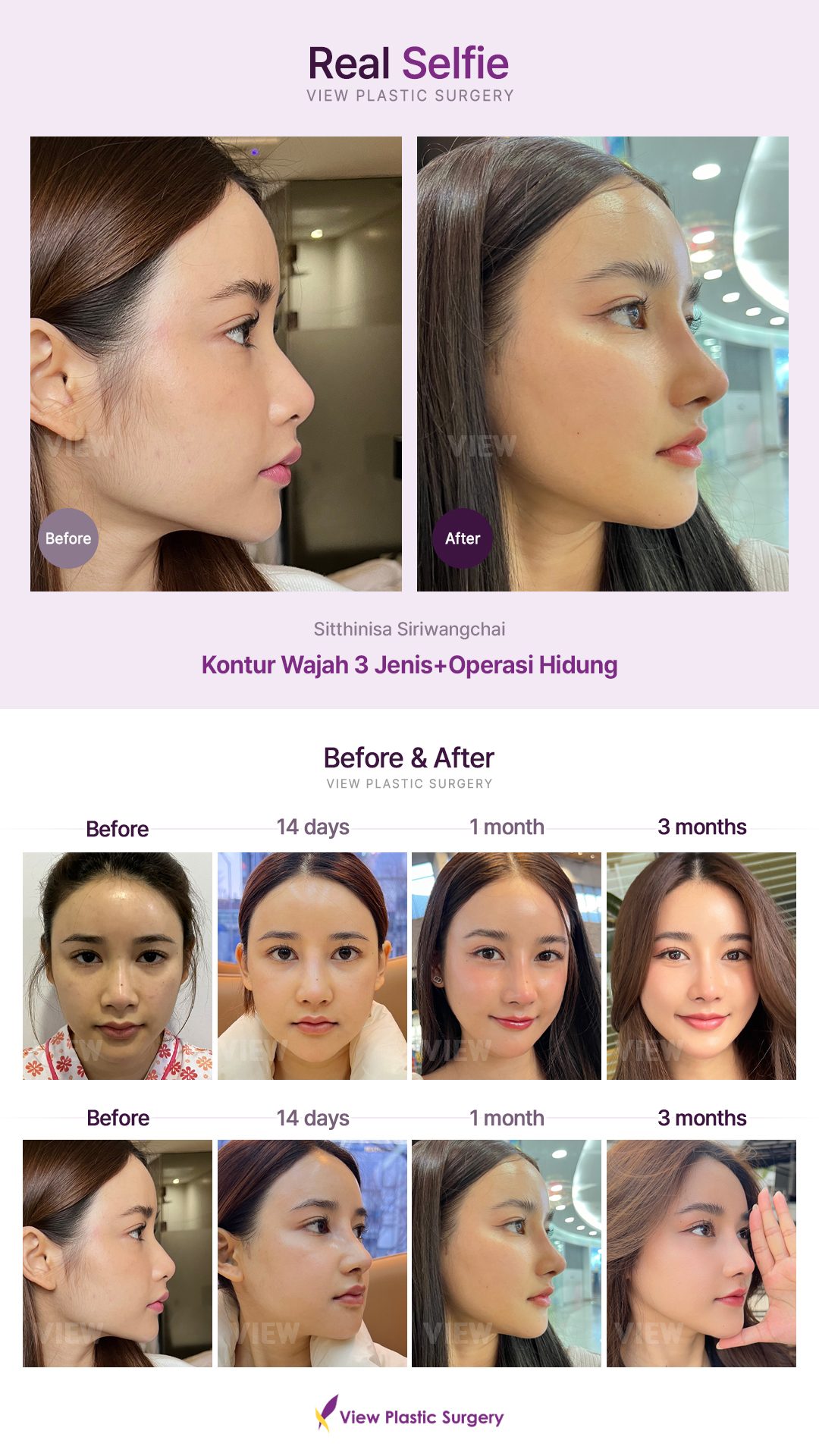 Kontur Wajah 3 Jenis + Operasi Hidung