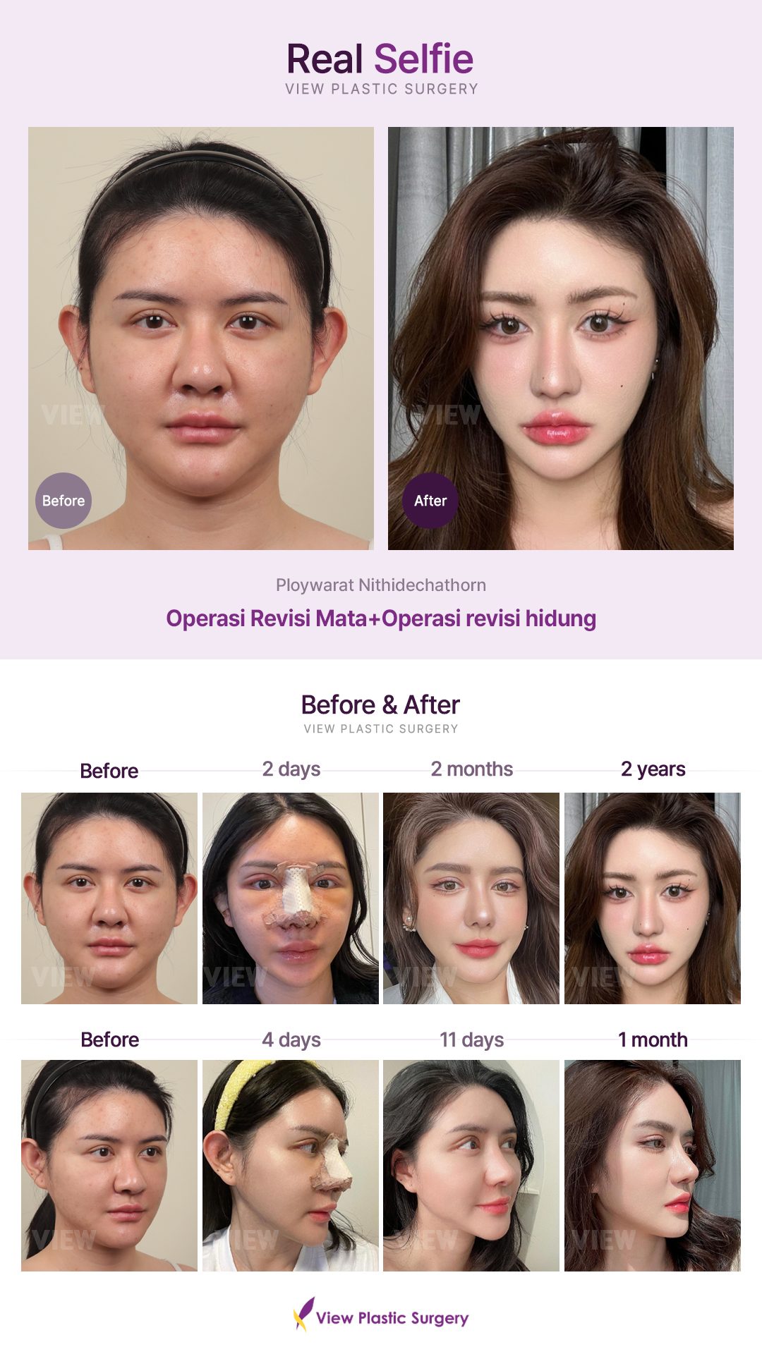 Operasi Revisi Mata+Operasi revisi hidung