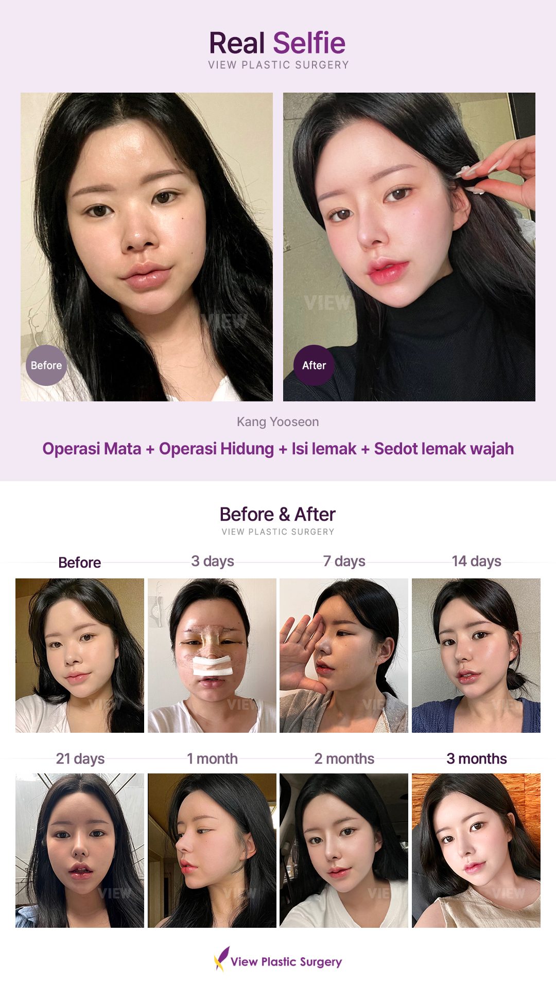 Operasi Mata, Operasi Hidung, Isi lemak, Sedot lemak wajah