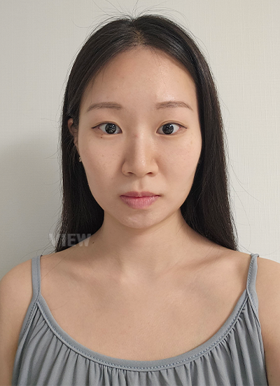 Review Klinik Bedah Plastik View, Rhinoplasty di Korea Selatan, Rhinoplasty, Face Contour di Korea Selatan