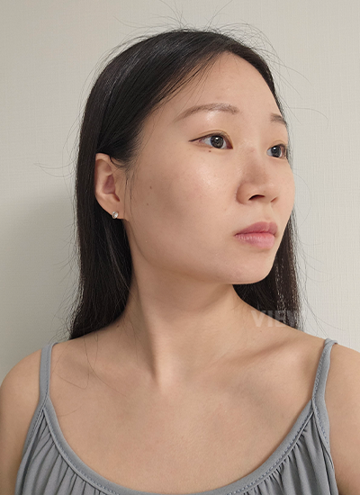 Operasi Face Contour, Review Rhinoplasty di Klinik Bedah Plastik View
