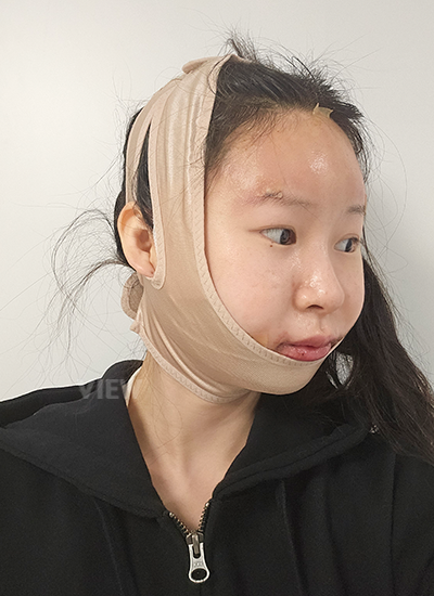 Review hari ke-3 Operasi Rhinoplasty, Face Contour, Fat Graft