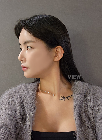 face contour surgery in Korea
