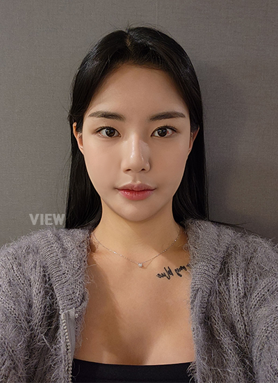 3 weeks after facial contouring surgery