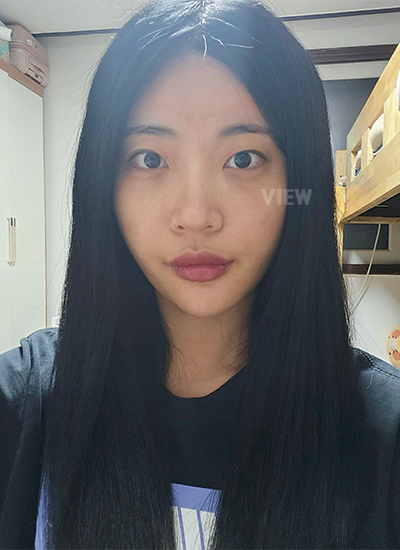 Koreksi bentuk mata, Review operasi mata di View Plastic Surgery 