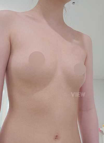 Review Klinik Bedah Plastik View, Sedot lemak, Pengecilan areola