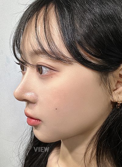 review facial contouring surgery korea