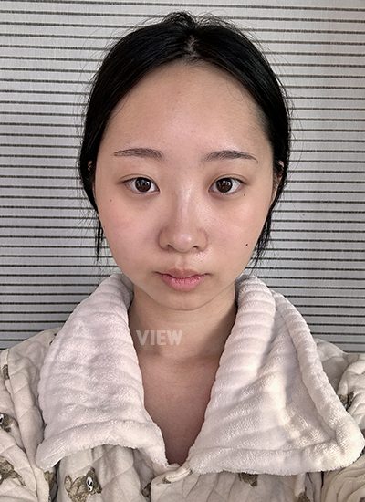 Review View Plastic Surgery, Kontur Wajah, Konsultasi Operasi Plastik, Biaya operasi pengecilan tulang pipi dan rahang kotak 