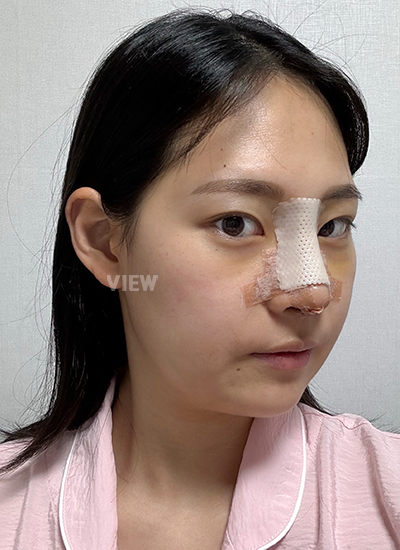 3 hari setelah oplas hidung di korea