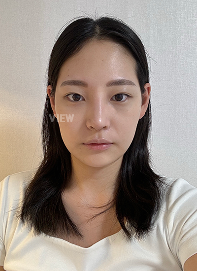 Oplas hidung korea, operasi hidung natural, pengecilan cuping hidung