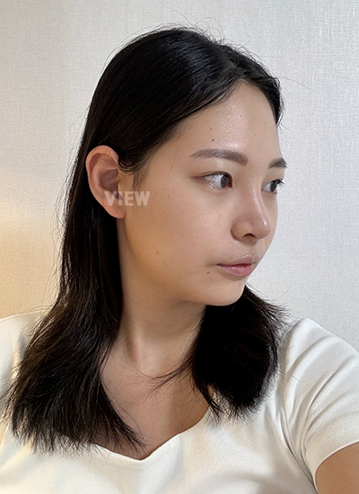 Review 2 minggu setelah operasi hidung di View Plastic Surgery Korea