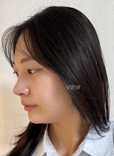 Operasi hidung mancung, 3 minggu setelah operasi hidung di Korea