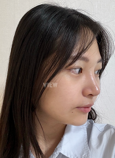 2 minggu setelah operasi plastik di Korea