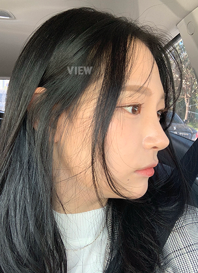implan silikon operasi hidung
