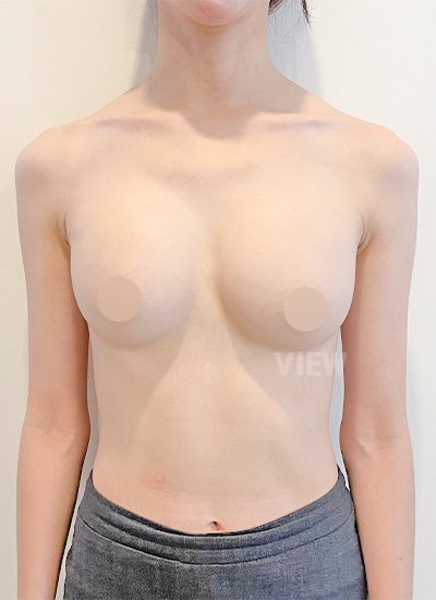 Review revisi payudara di View Plastic Surgery, Korea