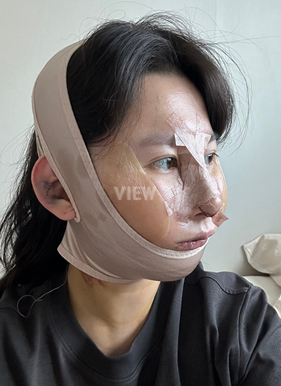 review 3 hari setelah operasi di Korea