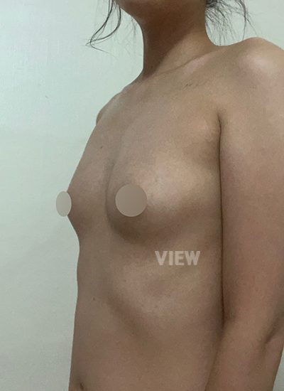 Review Pengalaman Operasi Payudara di Korea  (VIEW Plastic Surgery)