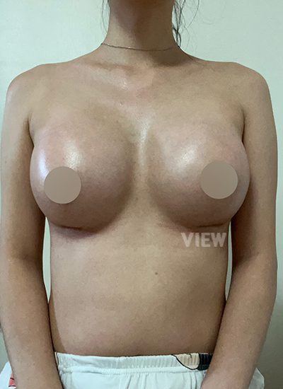 Perih setelah operasi payudara