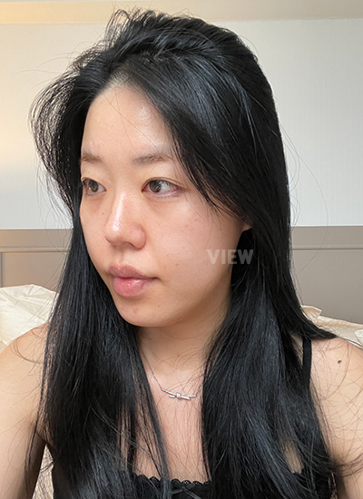 Review Operasi Plastik Korea: Pengalaman Saya di Klinik Operasi Plastik Seoul (Sebelum & Sesudah 4 Bulan)