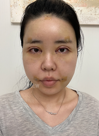 saya tidak merasakan sakit sama sekali pada mata.