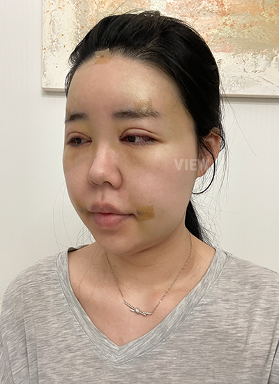 Hari ke-3 Setelah Operasi Plastik Korea