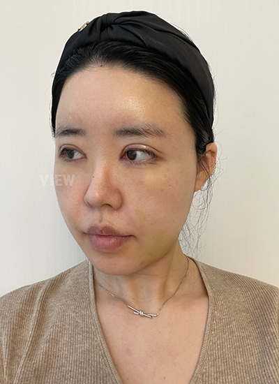 7 hari setelah operasi mata di Korea