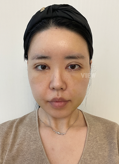 Hari ke-7 Pemulihan Operasi Plastik Korea