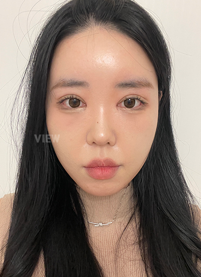 Operasi tarik benang di Korea