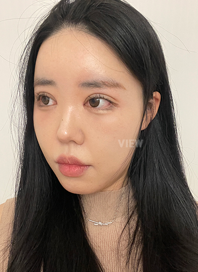 2 minggu setelah operasi mata di korea