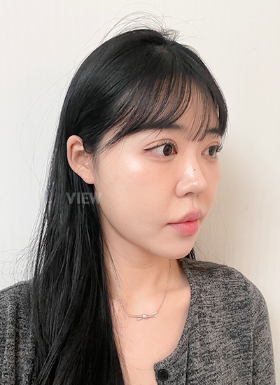 3 minggu setelah oplas di View Plastic Surgery Korea