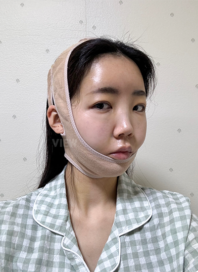 Sudah 3 hari sejak saya menjalani operasi plastik di Korea, termasuk thread lift, transfer lemak, dan sedot lemak wajah.