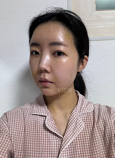 Walaupun minggu pertama tidak nyaman, bengkaknya perlahan berkurang.