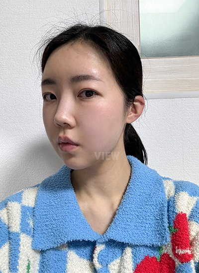 Sekarang sudah 2 minggu sejak saya operasi di View, salah satu klinik kecantikan Korea yang terkenal.
