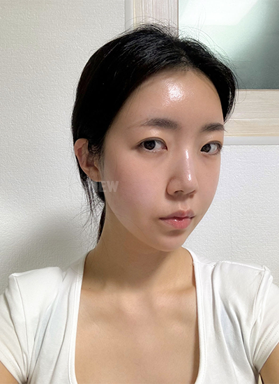 Sudah 3 minggu sejak saya operasi di klinik operasi plastik Korea, dan waktu terasa cepat sekali. Bengkak dan memar sebagian besar sudah hilang,