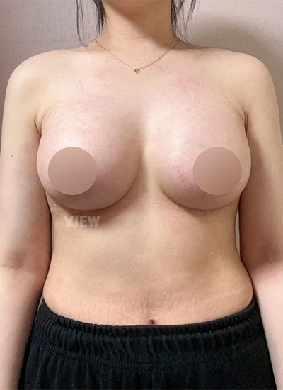 Minggu ketiga setelah bedah pembesaran payudara Korea, pembengkakan mulai menurun.