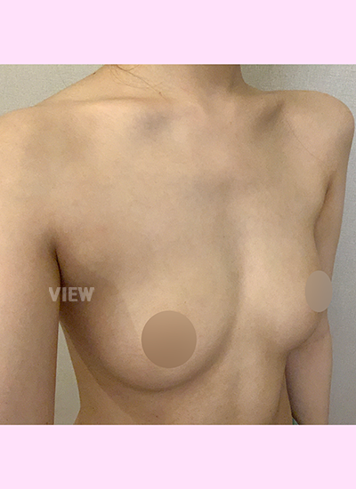 Ini adalah review konsultasi saya setelah mengunjungi sebuah rumah sakit Korean plastic surgery terkenal untuk melakukan breast augmentation in Korea.