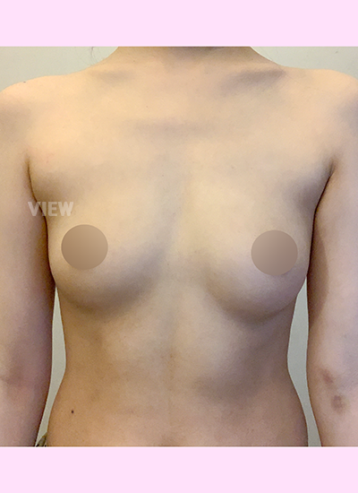 Mengapa Saya Memilih Korean Plastic Surgery untuk Breast Augmentation di Korea?