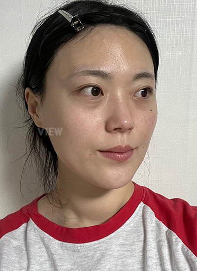 Kenapa Aku Sangat Gugup 1 Minggu Sebelum Facial Contouring Surgery?