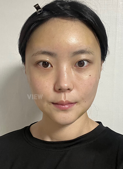 Apakah Wajar Wajah Masih Sangat Bengkak 1 Minggu Setelah Facial Contouring Surgery?