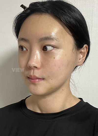 Apakah Wajar Wajah Masih Sangat Bengkak 1 Minggu Setelah Facial Contouring Surgery?