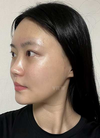Kenapa Wajahku Terasa Hampir Tidak Berubah 3 Minggu Setelah Facial Contouring Surgery?