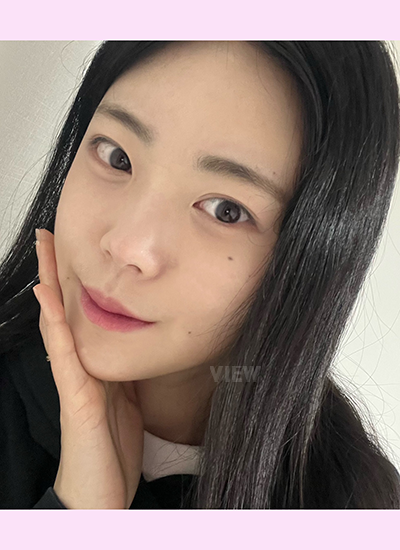 Kenapa Dagu Masih Terlihat Bengkak 3 Bulan Setelah Facial Contouring Surgery?