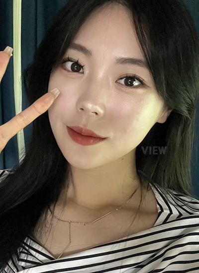 7 Bulan Setelah Operasi Kontur Wajah di Korea