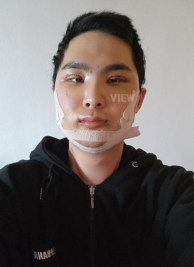 Sebelum operasi, saya sangat gugup. Namun, seperti yang banyak orang katakan dalam ulasan, begitu anestesi dimulai, saya menutup mata dan saat membukanya, operasi sudah selesai.
