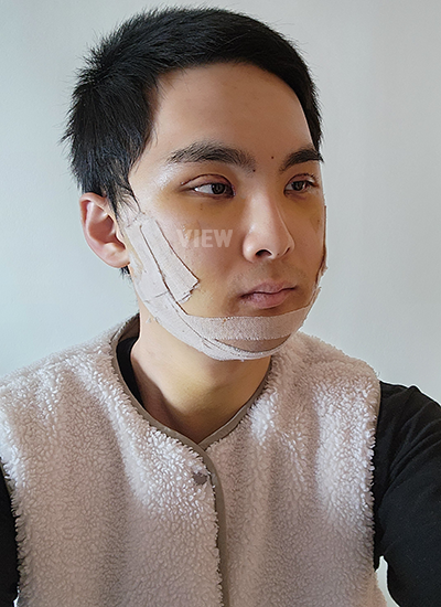 Hari ke-4 hingga ke-7 Setelah Operasi di Klinik Operasi Plastik Korea